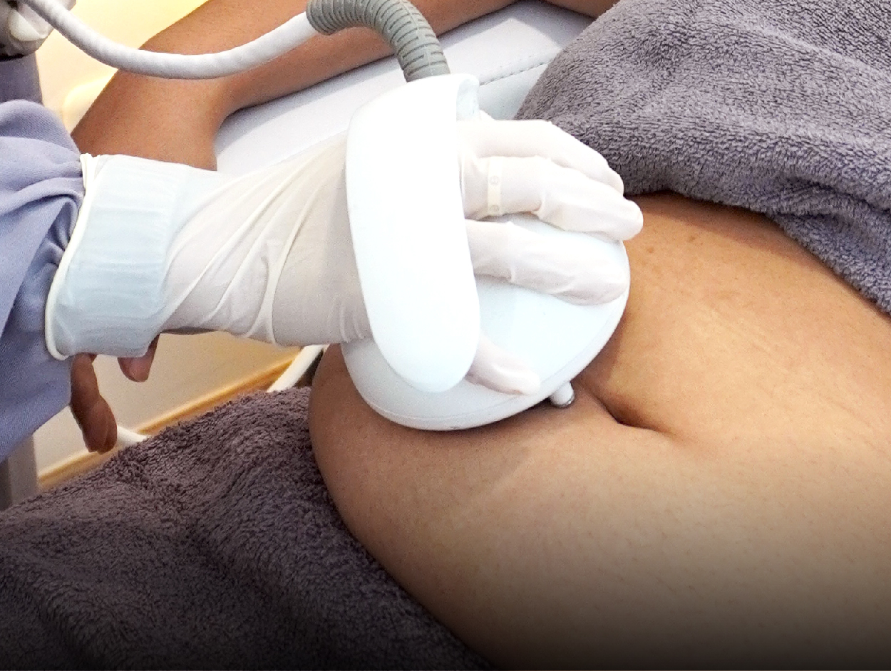 image of Octipolar RF