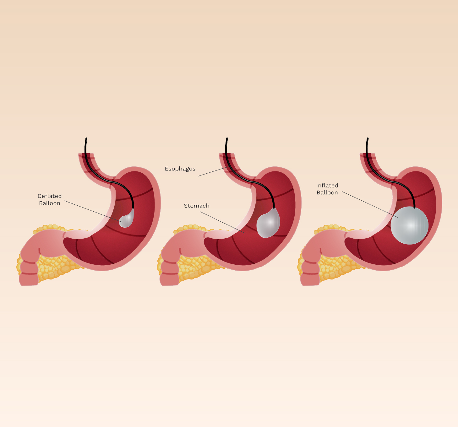 image of LW BariatriX - Balloon